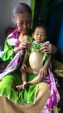 Perutnya Terserang Tumor Ganas, Bocah  15 Bulan Asal Banyuwangi Butuh Uluran Dermawan
